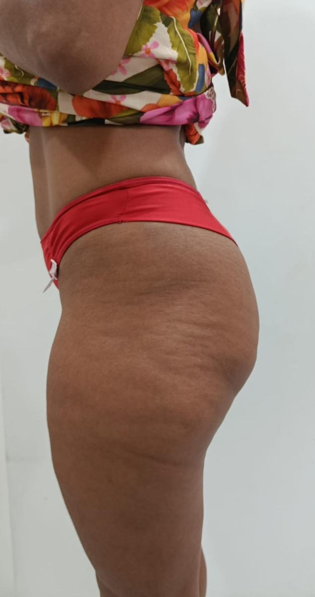 Antes - Mais volume e definição natural