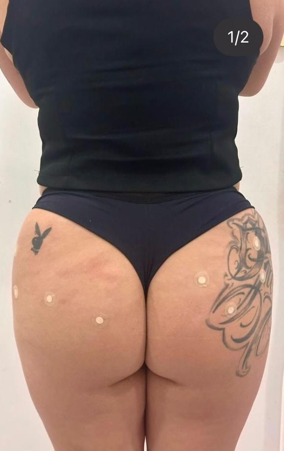 Depois - Contorno harmonioso e proporcional