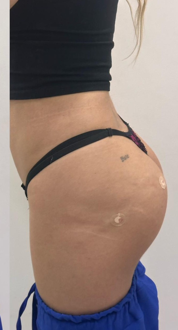 Depois - Equilíbrio e simetria corporal